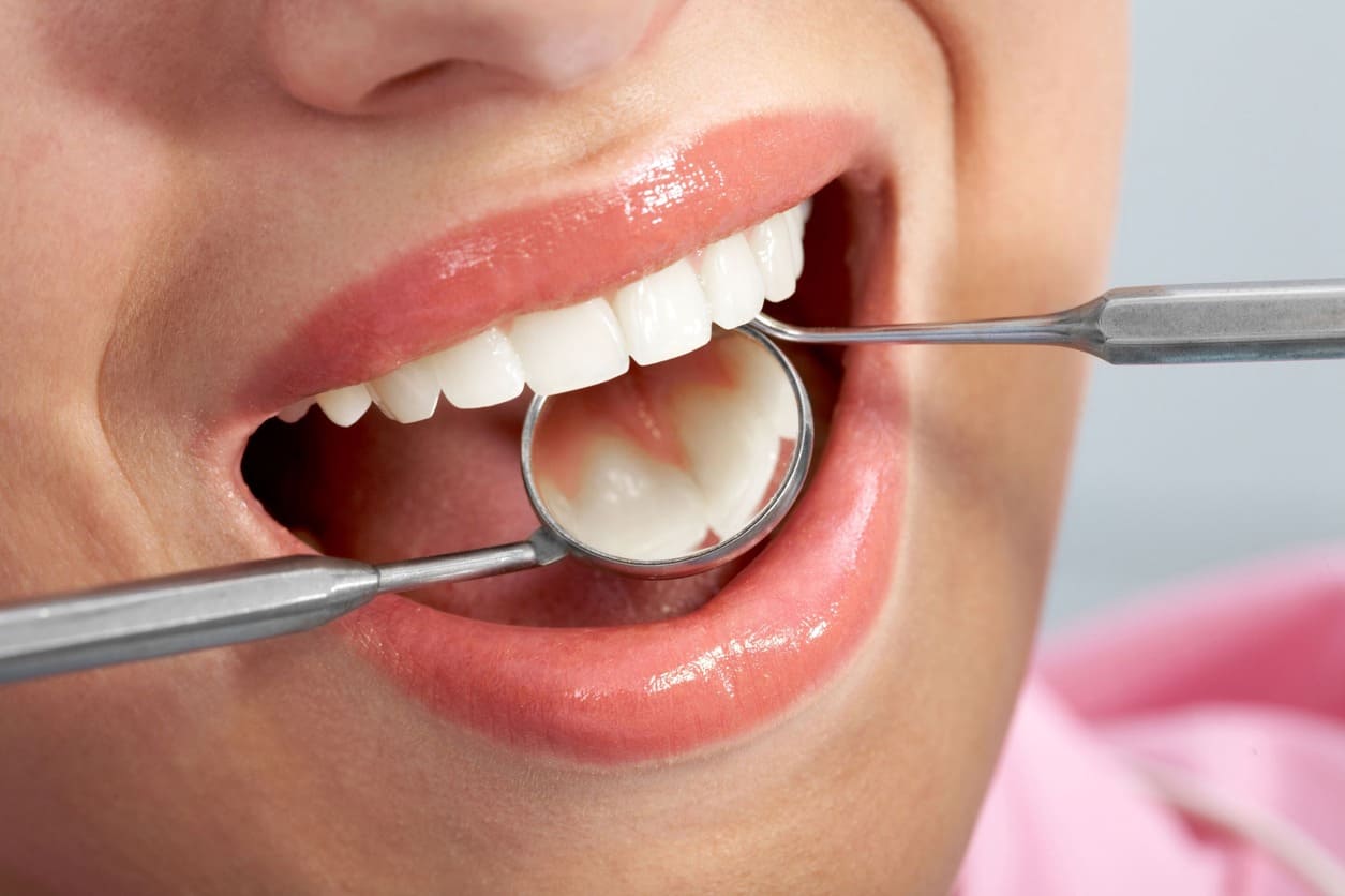 tooth filling