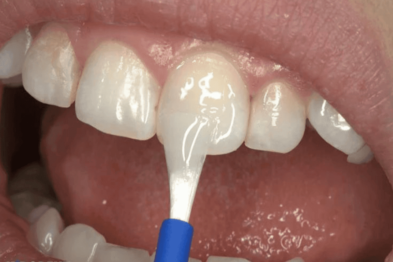 fluoride treatment