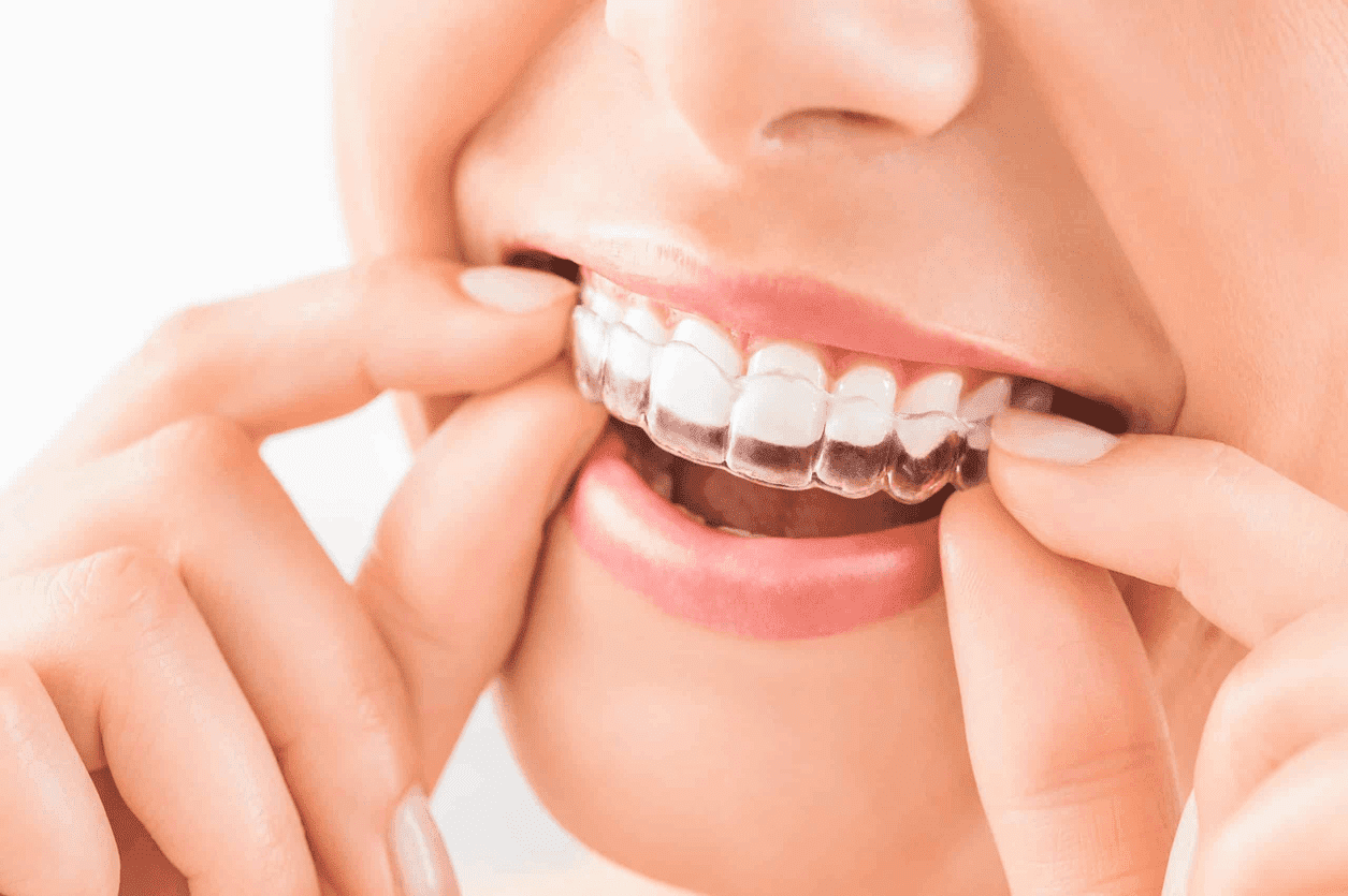 invisible retainer