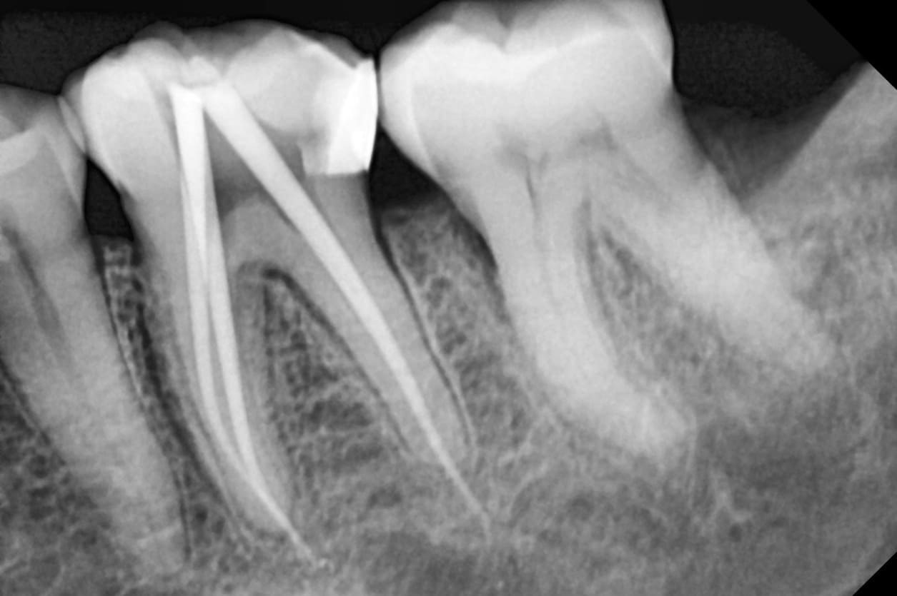 periapical radiograph