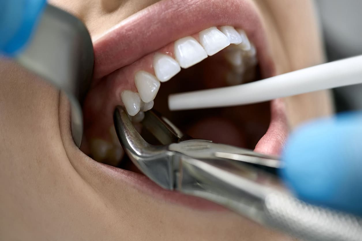 tooth extraction