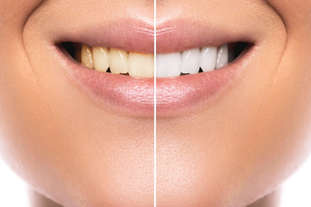 tooth whitening