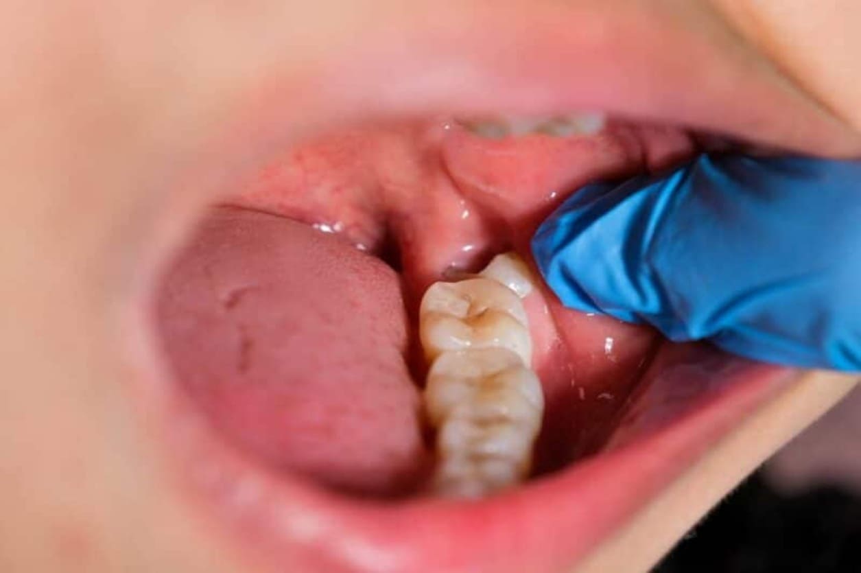 wisdom tooth removal